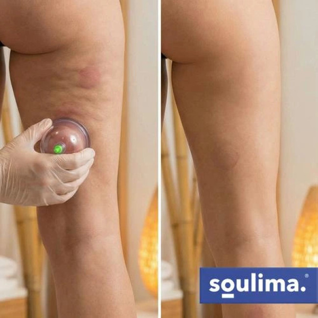 Вакуумні китайські банки Soulima 27292